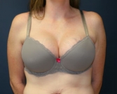 Feel Beautiful - Breast Implants San Diego, Case 49a - After Photo